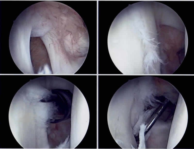 Bildserie einer arthroskopisch durchgeführten Schulterstabilisierung